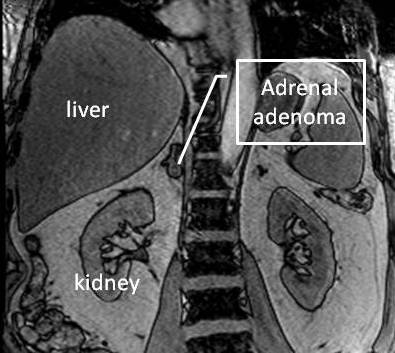 adrenal_adenoma_MRI2