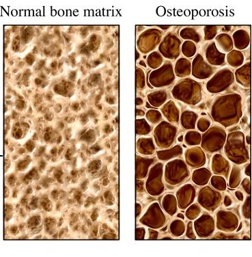 osteoporosis2